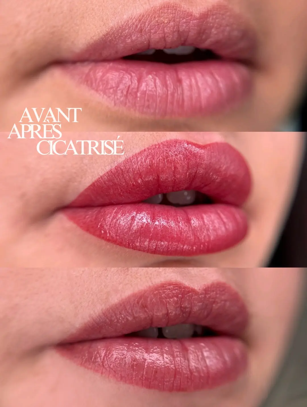 Lèvres — résultat naturel